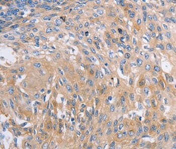Immunohistochemical analysis of paraffin-embedded Human cervical cancer tissue using #36997 at dilution 1/60.