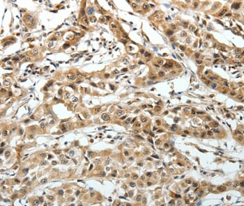 Immunohistochemical analysis of paraffin-embedded Human lung cancer tissue using #37069 at dilution 1/20.