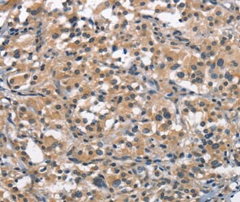 Immunohistochemical analysis of paraffin-embedded Human thyroid cancer tissue using #37143 at dilution 1/30.