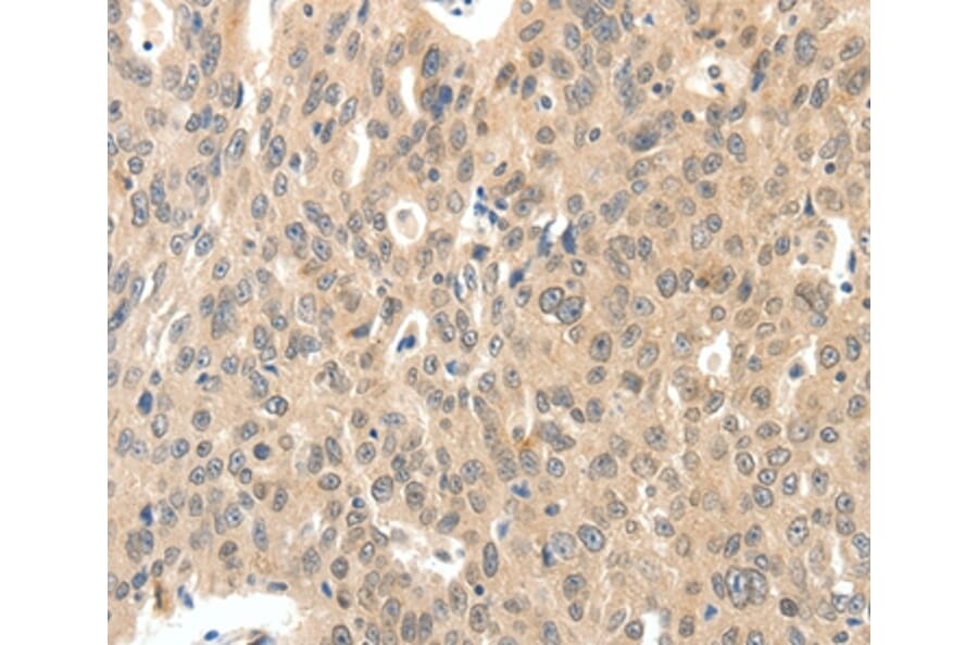 Immunohistochemistry - ROS1 Antibody from Signalway Antibody (37230) - Antibodies.com