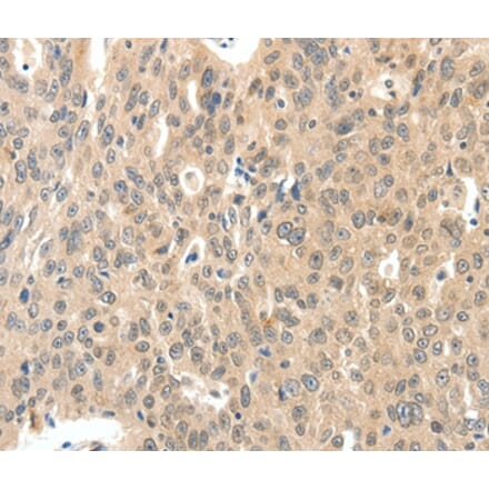 Immunohistochemistry - ROS1 Antibody from Signalway Antibody (37230) - Antibodies.com