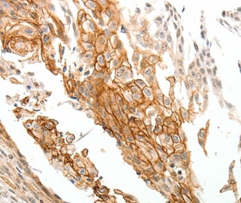 Immunohistochemical analysis of paraffin-embedded Human cervical cancer tissue using #37273 at dilution 1/25.