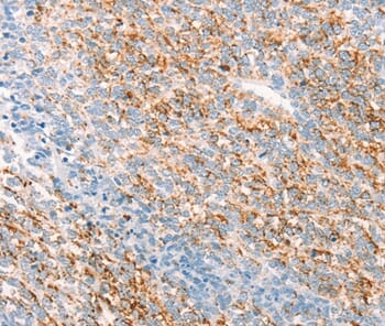 Immunohistochemical analysis of paraffin-embedded Human ovarian cancer tissue using #37275 at dilution 1/25.