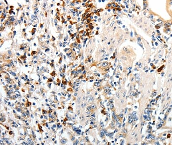 Immunohistochemical analysis of paraffin-embedded Human gastric cancer tissue using #37276 at dilution 1/60.