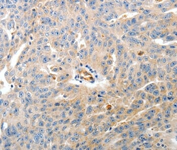 Immunohistochemical analysis of paraffin-embedded Human ovarian cancer tissue using #37276 at dilution 1/60.