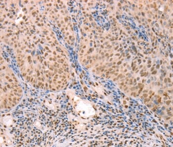 Immunohistochemical analysis of paraffin-embedded Human lymphoma tissue using #37277 at dilution 1/25.