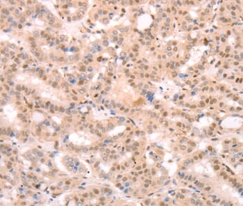 Immunohistochemical analysis of paraffin-embedded Human thyroid cancer tissue using #37277 at dilution 1/25.