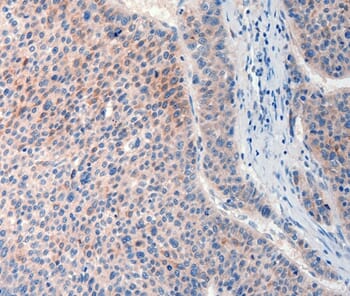Immunohistochemical analysis of paraffin-embedded Human liver cancer tissue using #37293 at dilution 1/20.