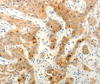 Immunohistochemical analysis of paraffin-embedded Human lung cancer tissue using #37293 at dilution 1/20.