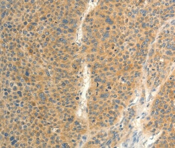 Immunohistochemical analysis of paraffin-embedded Human thyroid cancer tissue using #37294 at dilution 1/20.