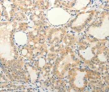 Immunohistochemical analysis of paraffin-embedded Human liver cancer tissue using #37294 at dilution 1/20.