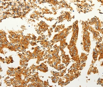 Immunohistochemical analysis of paraffin-embedded Human thyroid cancer tissue using #37296 at dilution 1/60.
