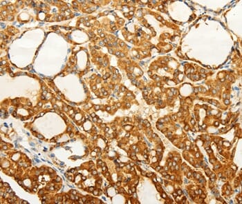 Immunohistochemical analysis of paraffin-embedded Human gastric cancer tissue using #37296 at dilution 1/60.