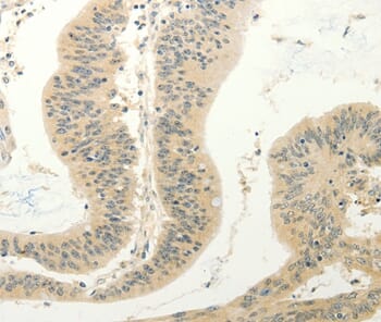 Immunohistochemical analysis of paraffin-embedded Human colon cancer tissue using #37297 at dilution 1/30.