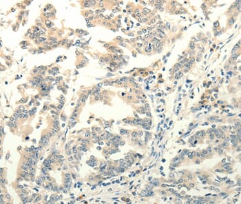 Immunohistochemical analysis of paraffin-embedded Human gastric cancer tissue using #37297 at dilution 1/30.