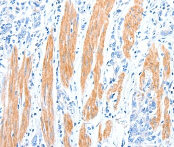Immunohistochemical analysis of paraffin-embedded Human gastric cancer tissue using #37321 at dilution 1/30.