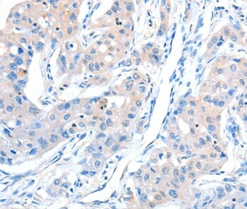 Immunohistochemical analysis of paraffin-embedded Human lung cancer tissue using #37321 at dilution 1/30.