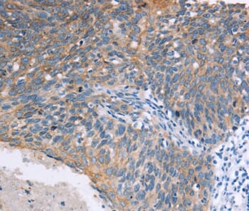 Immunohistochemical analysis of paraffin-embedded Human cervical cancer tissue using #37392 at dilution 1/15.