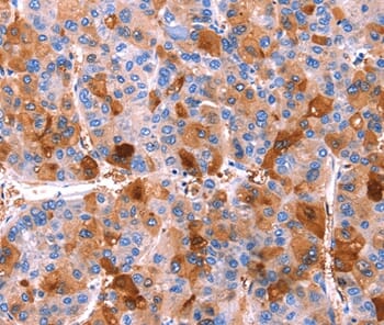 Immunohistochemical analysis of paraffin-embedded Human liver cancer tissue using #37554 at dilution 1/40.