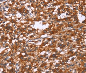 Immunohistochemical analysis of paraffin-embedded Human thyroid cancer tissue using #37590 at dilution 1/30.