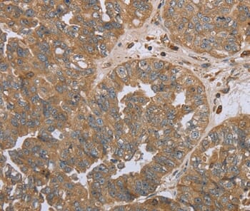 Immunohistochemical analysis of paraffin-embedded Human ovarian cancer tissue using #37763 at dilution 1/45.