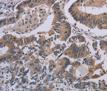 Immunohistochemical analysis of paraffin-embedded Human colon cancer tissue using #37765 at dilution 1/50.
