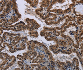 Immunohistochemical analysis of paraffin-embedded Human thyroid cancer tissue using #37770 at dilution 1/50.