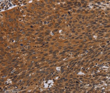 Immunohistochemical analysis of paraffin-embedded Human cervical cancer tissue using #37771 at dilution 1/40.