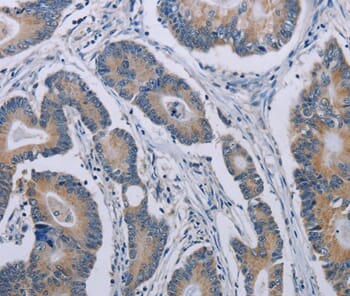 Immunohistochemical analysis of paraffin-embedded Human colon cancer tissue using #37772 at dilution 1/40.