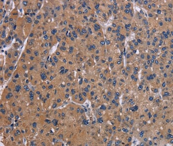 Immunohistochemical analysis of paraffin-embedded Human liver cancer tissue using #37774 at dilution 1/40.