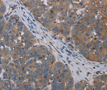Immunohistochemical analysis of paraffin-embedded Human ovarian cancer tissue using #37784 at dilution 1/30.