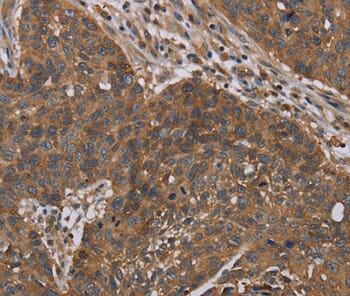 Immunohistochemical analysis of paraffin-embedded Human lung cancer tissue using #37785 at dilution 1/40.