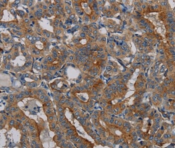 Immunohistochemical analysis of paraffin-embedded Human thyroid cancer tissue using #37814 at dilution 1/50.