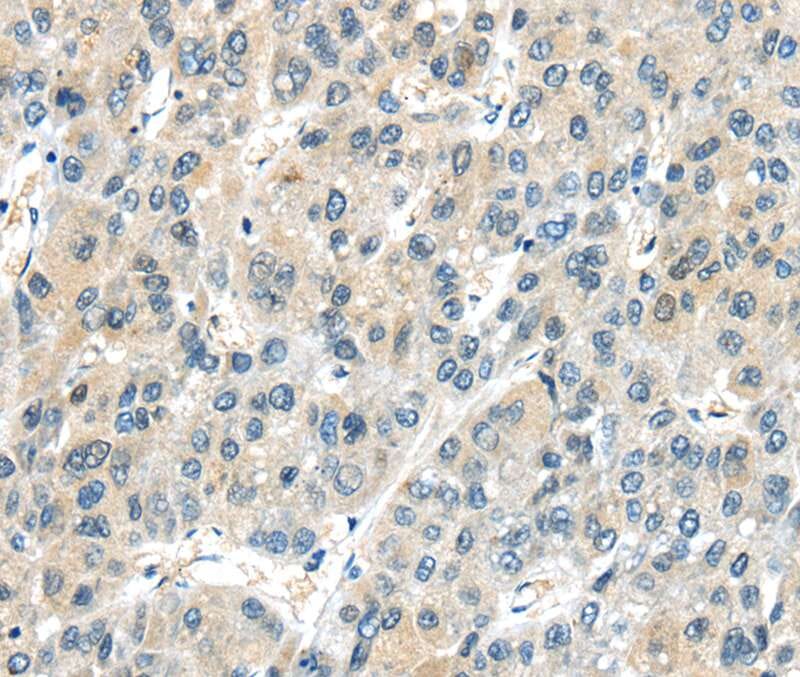 Immunohistochemical analysis of paraffin-embedded Human liver cancer tissue using #40189 at dilution 1/25.