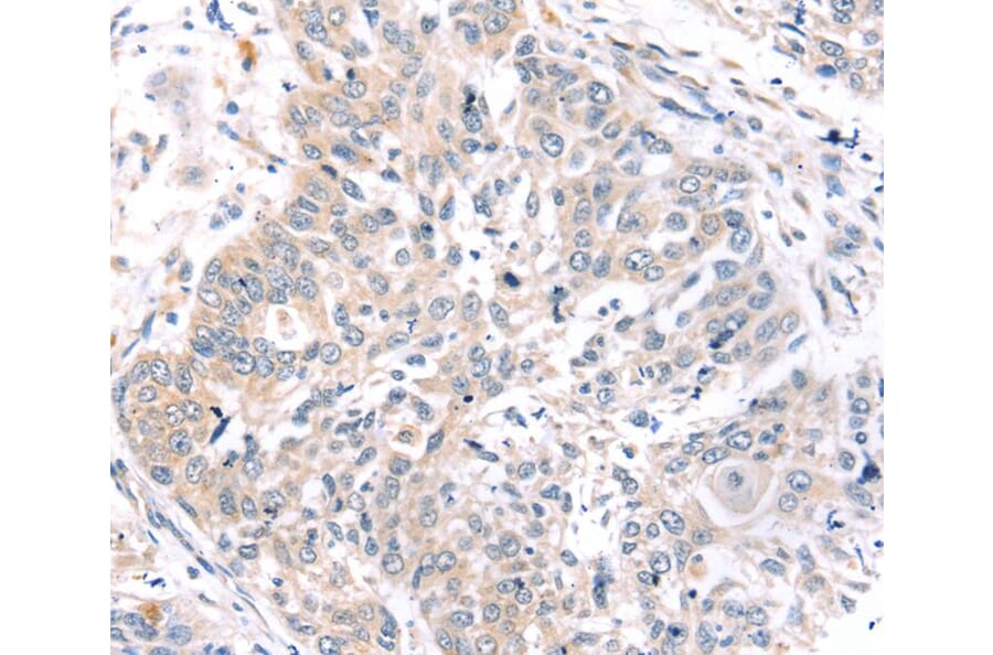 Immunohistochemistry - ROR1 Antibody from Signalway Antibody (40217) - Antibodies.com