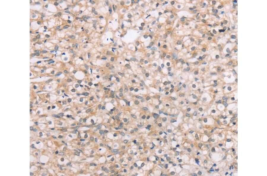 Immunohistochemistry - ROR1 Antibody from Signalway Antibody (40217) - Antibodies.com