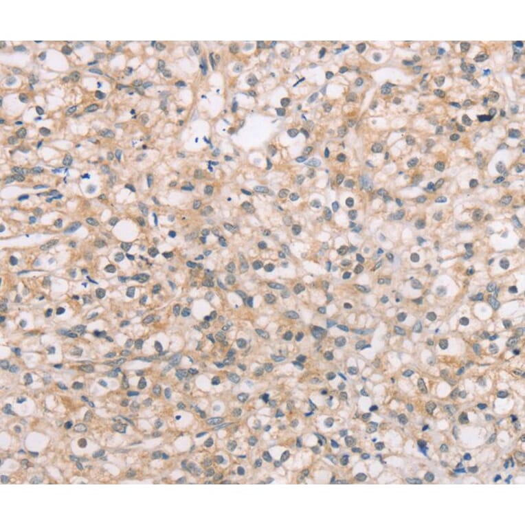 Immunohistochemistry - ROR1 Antibody from Signalway Antibody (40217) - Antibodies.com