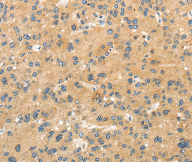 Immunohistochemical analysis of paraffin-embedded Human liver cancer tissue using #40288 at dilution 1/40.