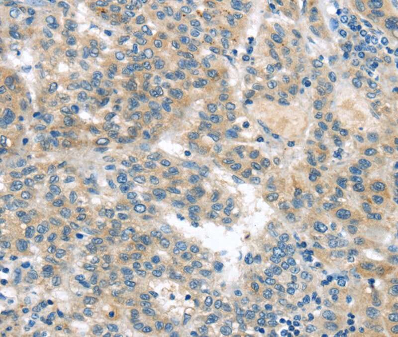 Immunohistochemical analysis of paraffin-embedded Human liver cancer tissue using #40401 at dilution 1/20.