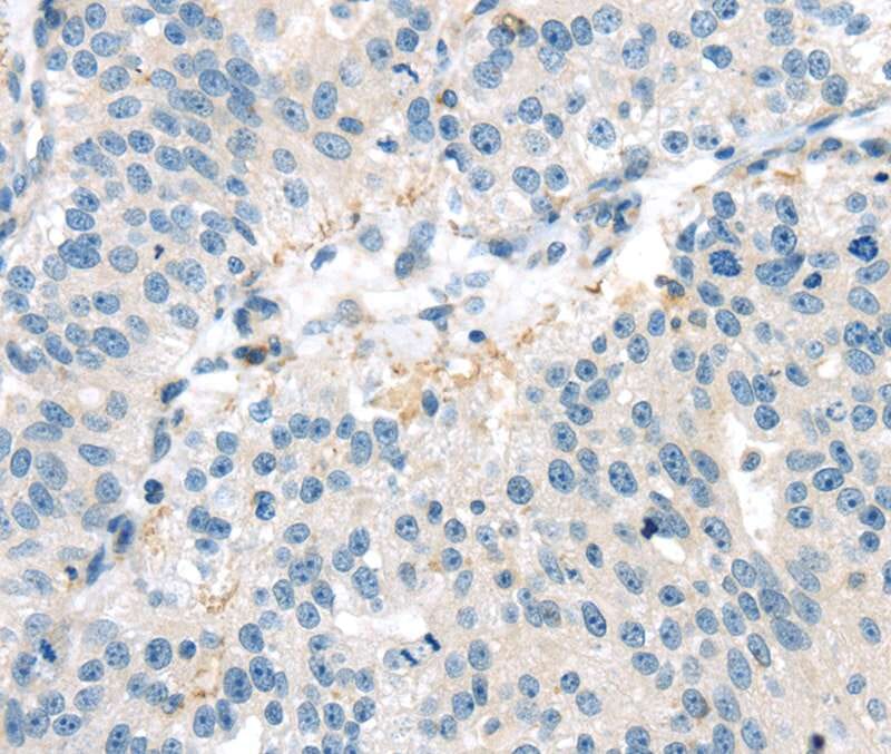 Immunohistochemical analysis of paraffin-embedded Human breast cancer tissue using #40401 at dilution 1/20.