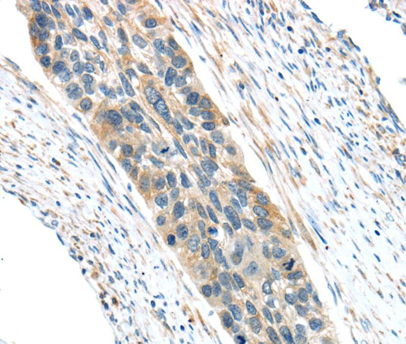 Immunohistochemical analysis of paraffin-embedded Human oesophagus cancer tissue using #40403 at dilution 1/30.
