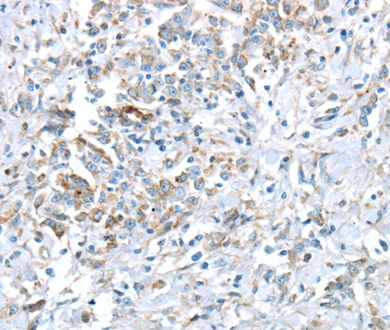 Immunohistochemical analysis of paraffin-embedded Human gastric cancer tissue using #40403 at dilution 1/30.