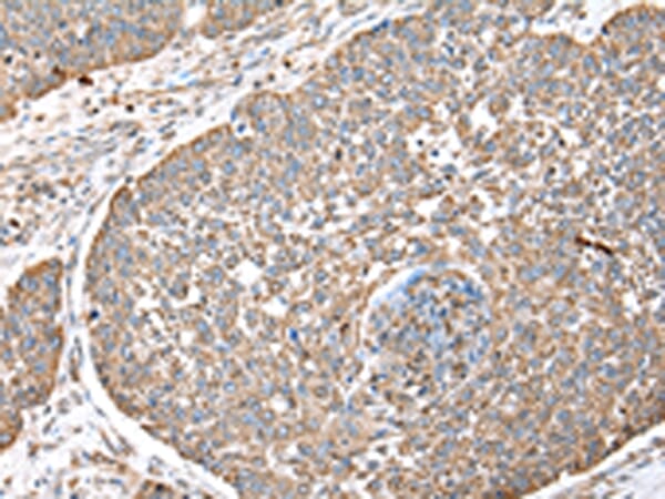 Immunohistochemical analysis of paraffin-embedded Human lung cancer tissue using #42855 at dilution 1/40.