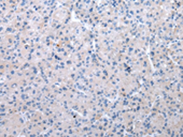 Immunohistochemical analysis of paraffin-embedded Human liver cancer tissue using #42864 at dilution 1/40,
