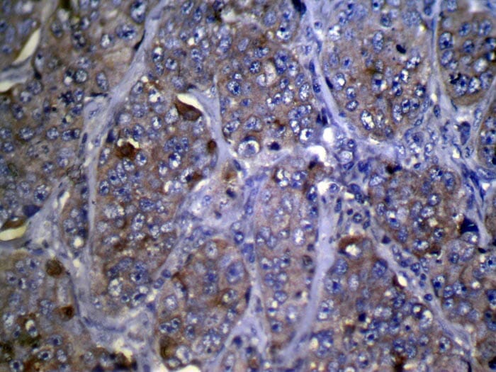 Immunohistochemical analysis of paraffin-embedded Human Breast cancer tissue using #42874 at dilution 1/100,