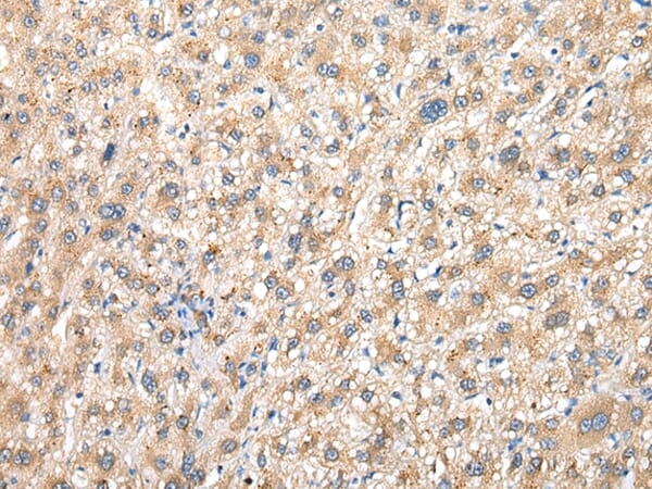 Immunohistochemical analysis of paraffin-embedded Human liver cancer tissue using #42923 at dilution 1/30.