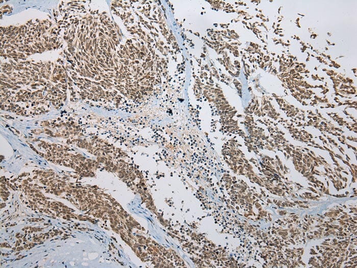 Immunohistochemical analysis of paraffin-embedded Human Lung cancer tissue using #42929 at dilution 1/200.