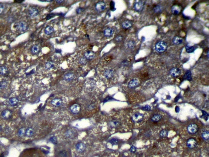 Immunohistochemical analysis of paraffin-embedded Human Liver cancer tissue using #42931 at dilution 1/100.
