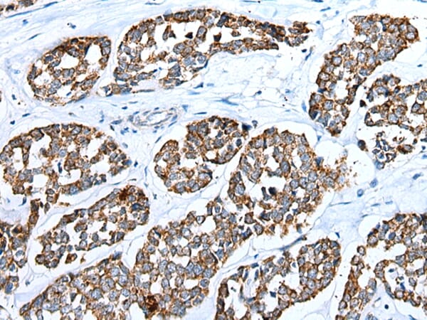 Immunohistochemical analysis of paraffin-embedded Human oesophagus cancer tissue using #42948 at dilution 1/25.