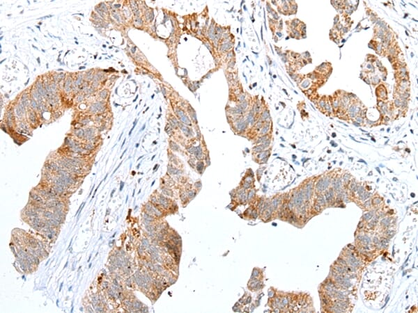 Immunohistochemical analysis of paraffin-embedded Human colorectal cancer tissue using #42948 at dilution 1/25.